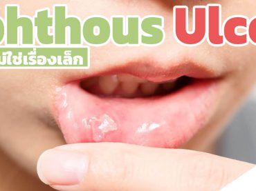 แผลร้อนใน ( Aphthous Ulcers ) ไม่ใช่เรื่องเล็ก