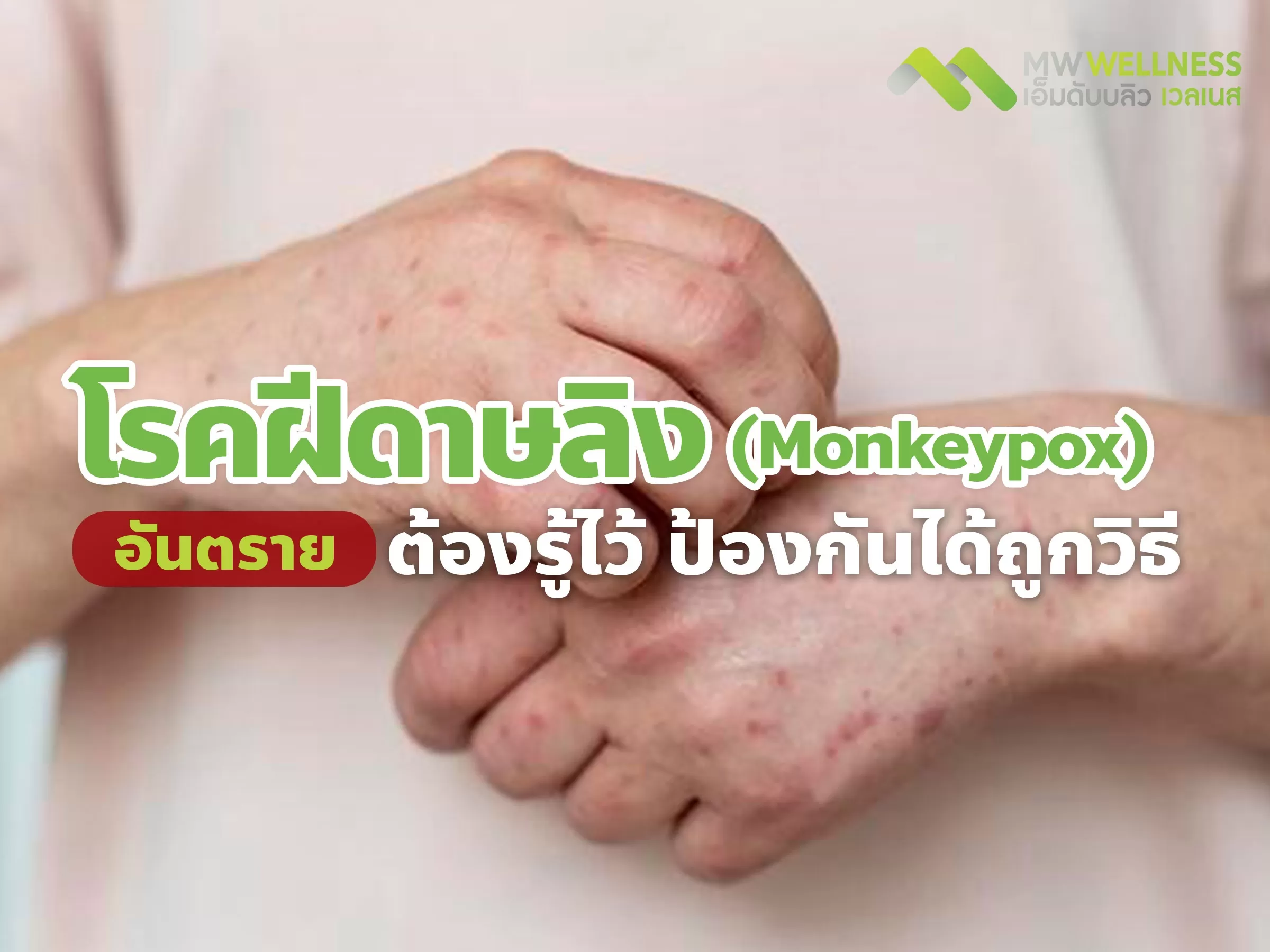 โรคฝีดาษลิง ( Monkeypox ) อันตราย ต้องรู้ไว้ ป้องกันได้ถูกวิธี